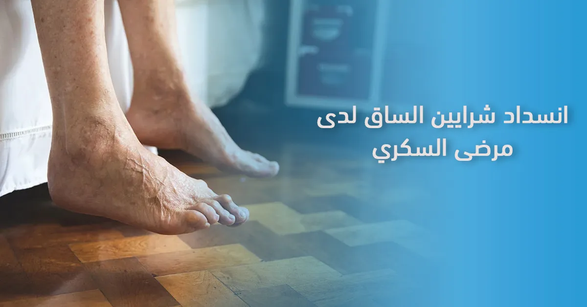 انسداد شرايين الساق لدى مرضى السكري